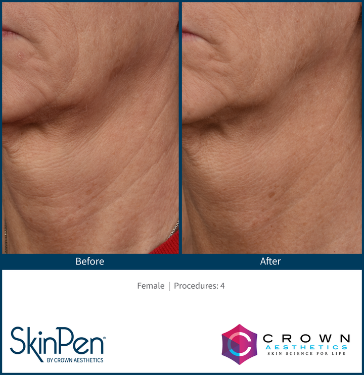 SkinPen Microneedling