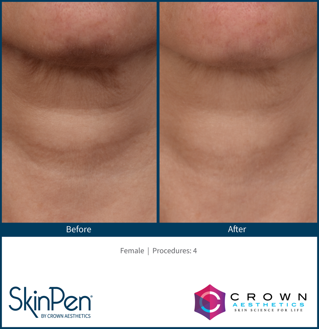 SkinPen Microneedling