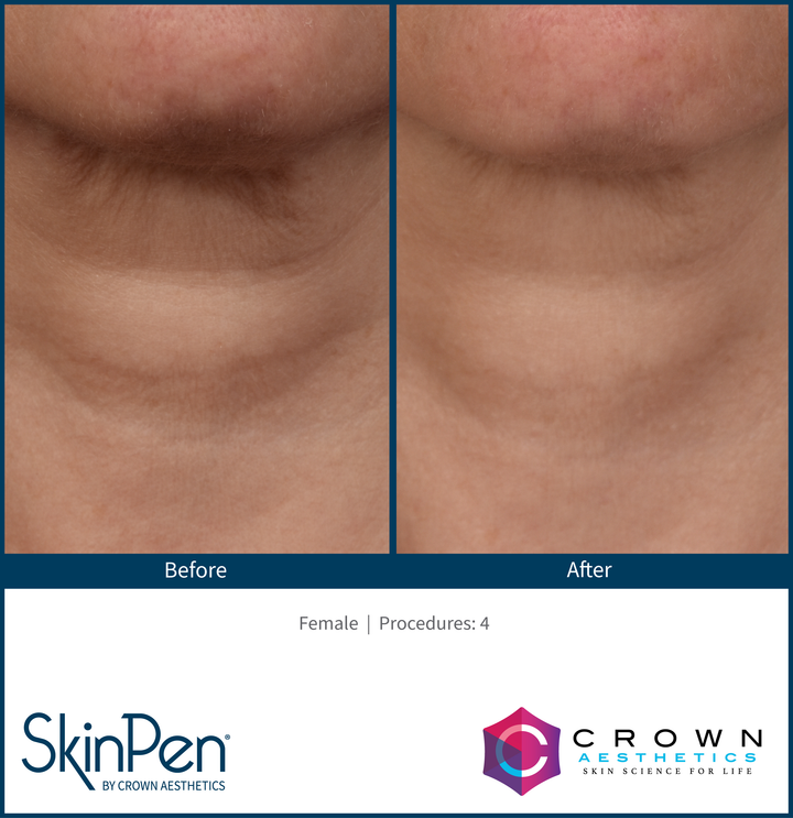 SkinPen Microneedling