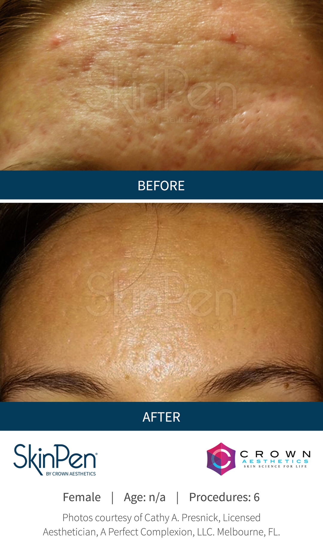 SkinPen Microneedling