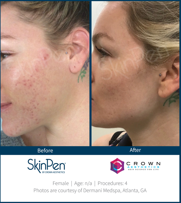 SkinPen Microneedling
