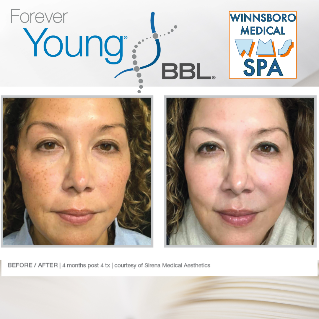 Sciton Forever Young BBL Treatment | Winnsboro Medical Spa