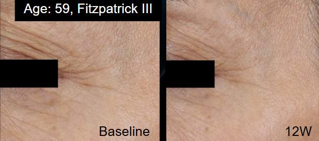 A.G.E. Interrupter Ultra Serum | Visible Lift